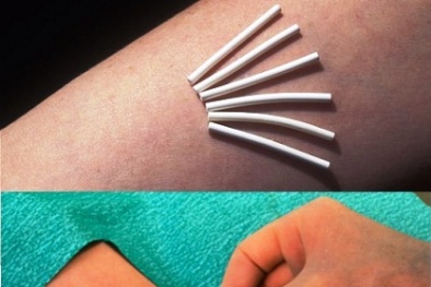 Khóc dở mếu dở vì cấy que  tránh thai